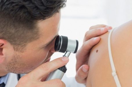 Melanoma: Kush rrezikohet më shumë nga shfaqja e saj?