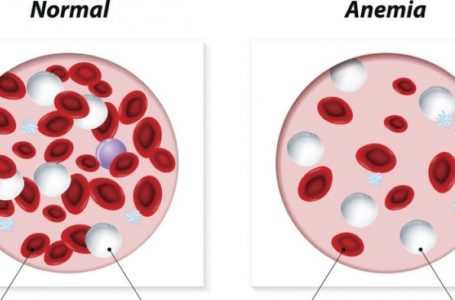 Anemia dhe ushqimet e duhura që luftojnë pagjakësinë