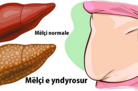 Simptomat që tregojnë se keni një mëlçi të yndyrosur