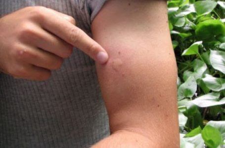 Thumbimi i insekteve dhe ndihma paraspitalore
