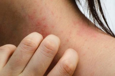 Simptomat e alergjisë ndaj penicilinës dhe kujdesi që ju duhet