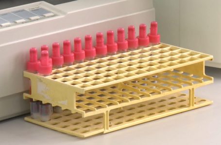 Në QKMF mungojnë epruvetat,nuk mund të bëhet testi D Dimer