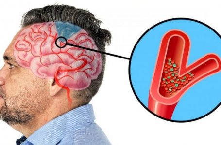 Çfarë duhet të dini rreth dhimbjes së kokës në anën e majtë