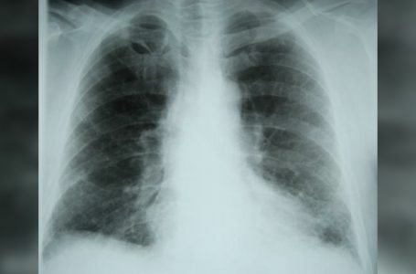 Jetishi: Një ndër shkaktarët e fibrozës pulmonare është COVID-19