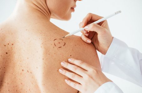 Qytetarët harxhojnë mbi 4 mijë euro në muaj për trajtimin e Melanomës, MSh thotë se sigurimi i citostatikëve është shumë i shtrenjtë
