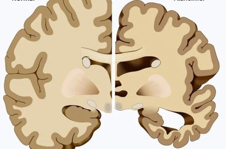 Cilat janë pesë fazat e Alzheimerit, sëmundje e harresës