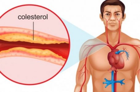 Këto shenja tregojnë se duhet të kontrolloni kolesterolin në gjak