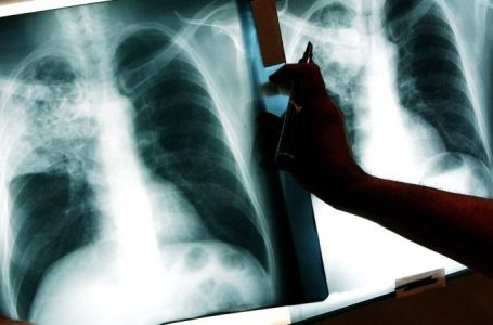 Vdekshmëria nga tuberkulozi në Evropë u rrit për herë të parë në 20 vjet