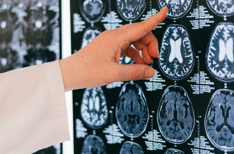 Zbulohet ilaçi për Alzheimerin, ndalon përparimin e sëmundjes