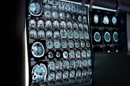 Shkencëtarët kanë zhvilluar markerët e rinj për diagnostikimin e hershëm të sklerozës së shumëfishtë