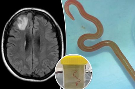Rasti i parë në botë, gruas i hiqet nga truri krimbi i gjallë 8 cm