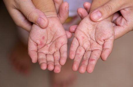 Shqipëri: Alarmi nga fruthi, cilat janë qarqet ku mund të ketë shpërthime epidemike