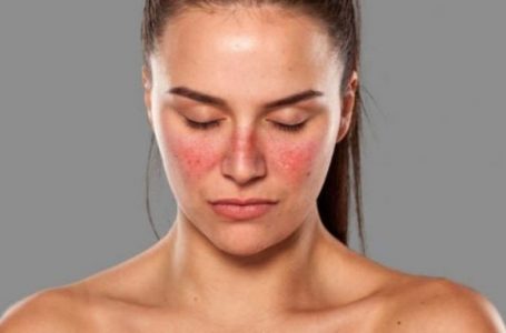 ​Dita Botërore e Lupus