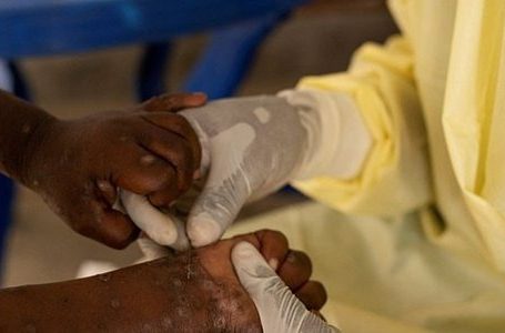 Shpërthim i ri i “mpox” në Afrikë, OBSH shpall emergjencë globale shëndetësore