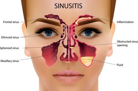 Sinusiti – shkaqet, simptomat, diagnoza dhe trajtimi