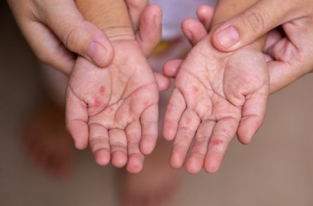 Fruthi prek tri komuna në Kosovë, konfirmohen pesë raste